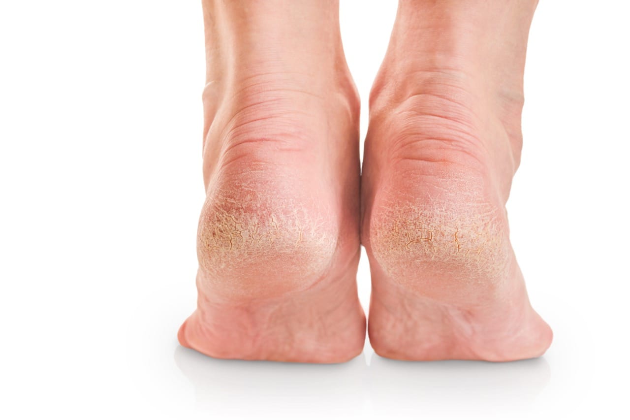 Votre pharmacienne vous propose LA solution contre les pieds secs